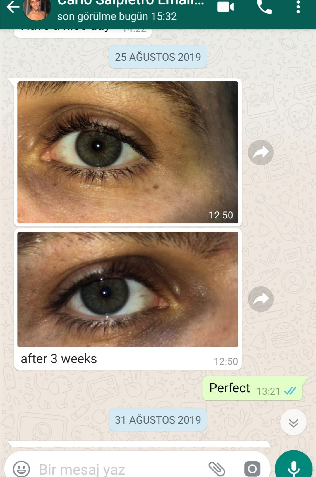 Side Effects, Costs, and Locations of Laser Eye Color Change Surgery