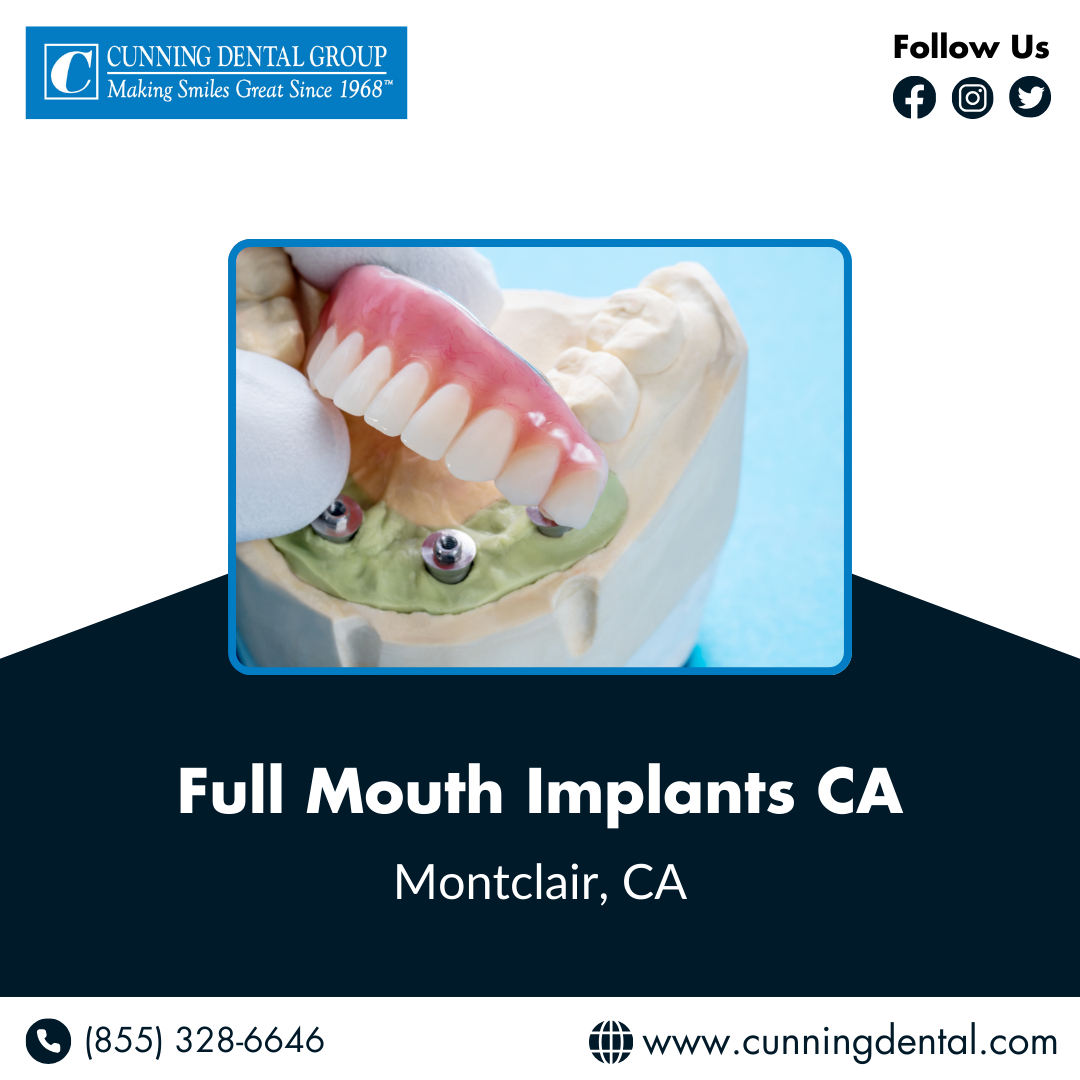 Full Mouth Implants Ca Cunning Dental Group Medium