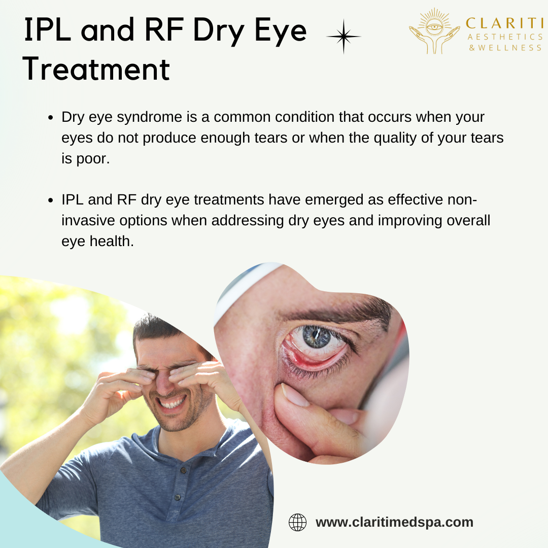 Comprehensive IPL and RF Dry Eye Treatment Results in Houston, TX by