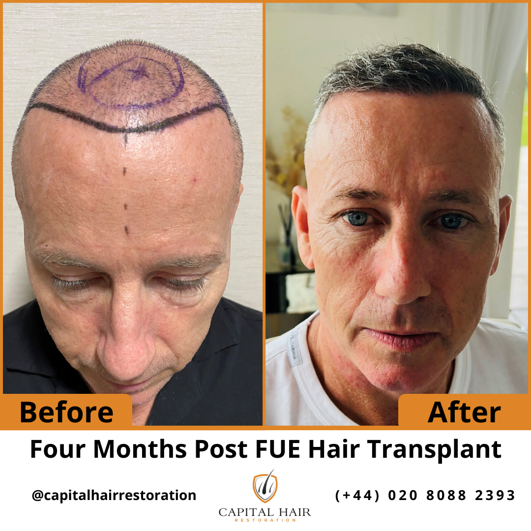 Capital Hair Restoration Pioneering Hair Transplantation Clinic in London by Hair Transplant