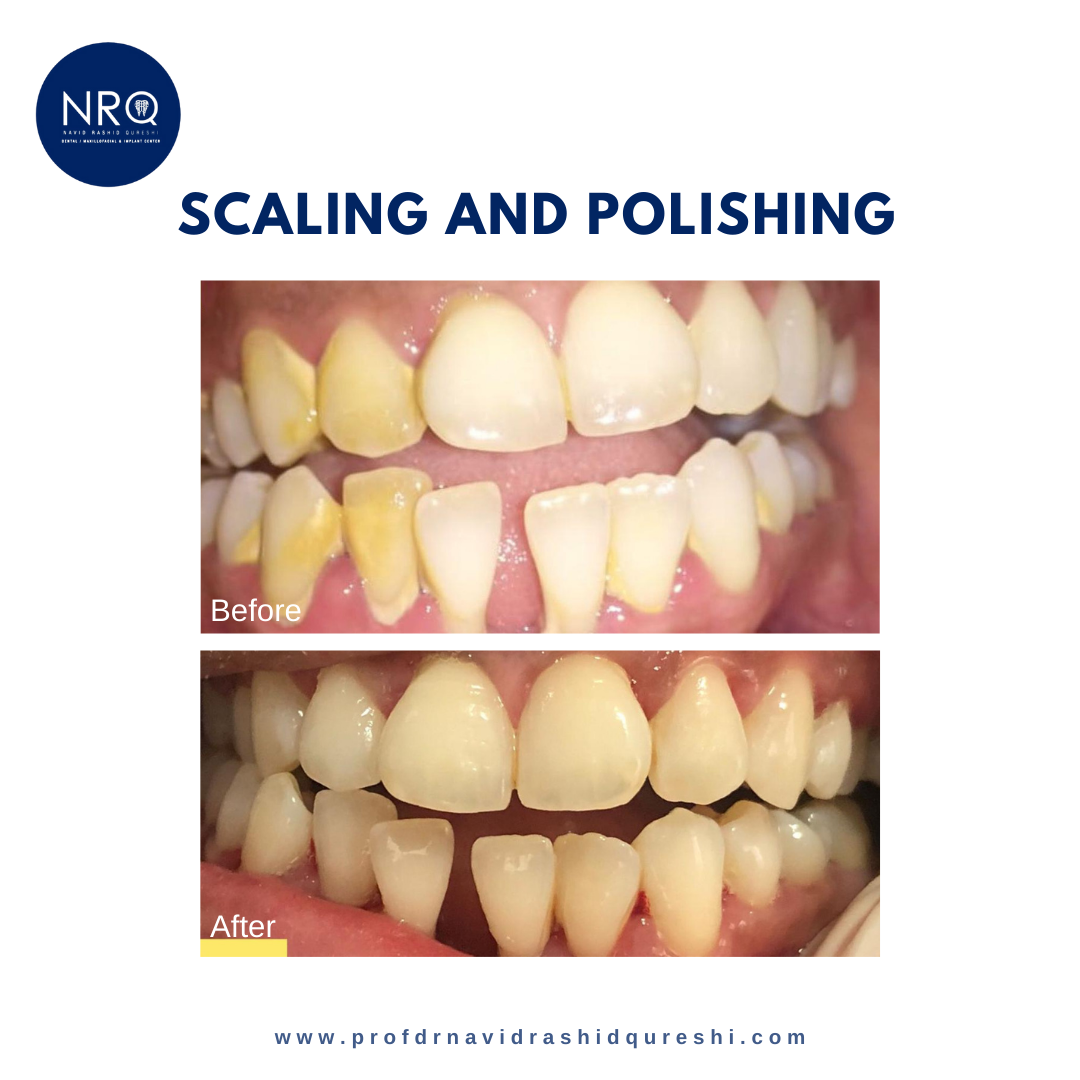 Scaling/ Polishing Treatment Drprofnavidqureshi Medium