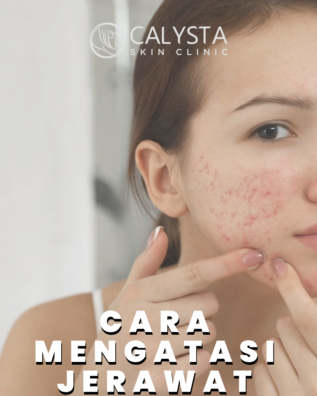Cara Menghilangkan Jerawat Parah