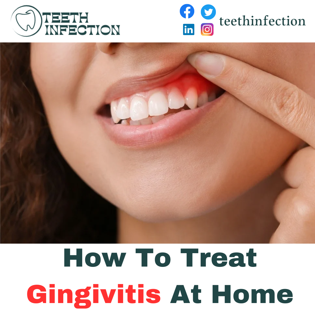 How To Treat Gingivitis At Home. Gingivitis is a common gum disease