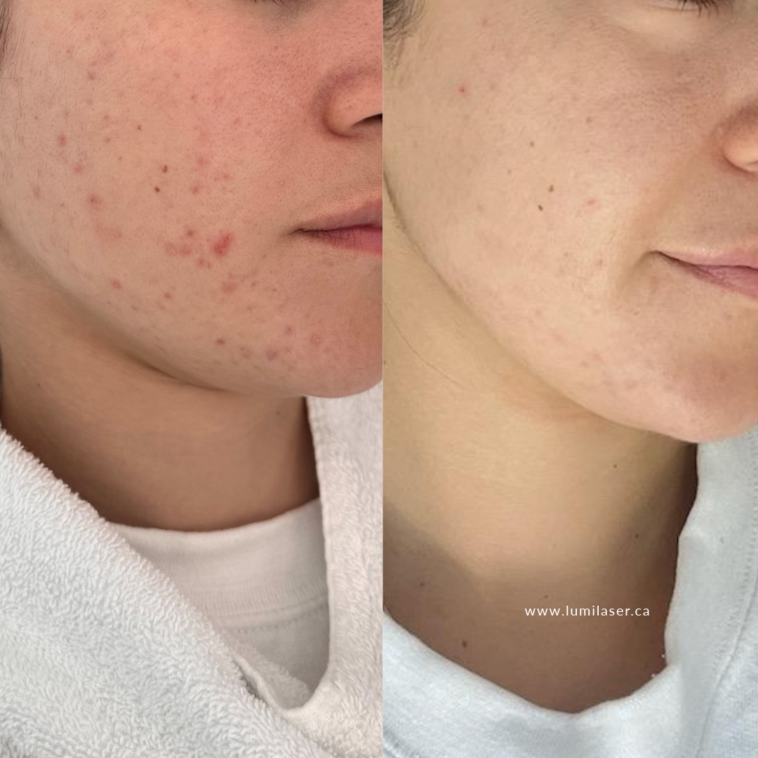 Laser Acne Montreal — Lumilaser