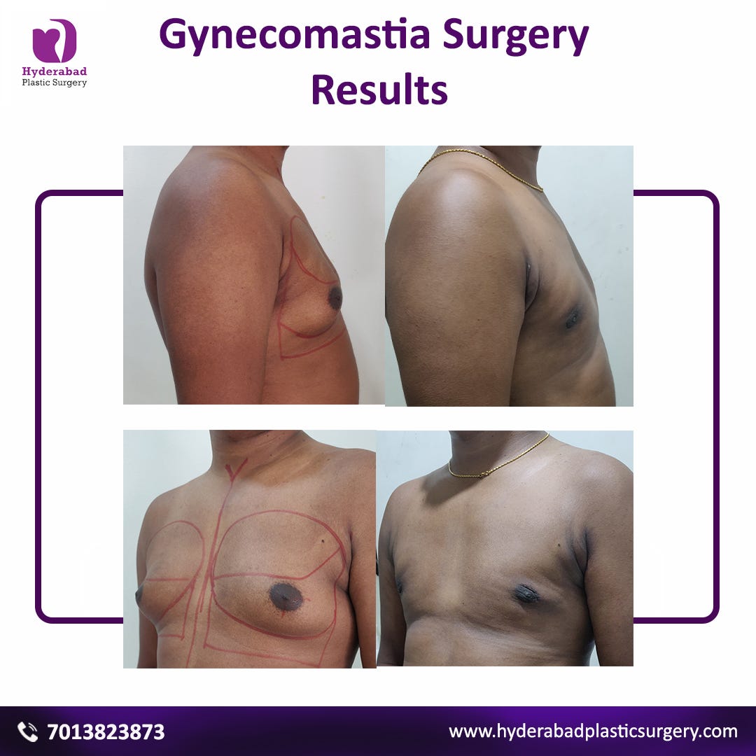 Breast reduction surgery (female)/Gynecomastia surgery (male): Procedure,  Purpose, Results, Cost, Price