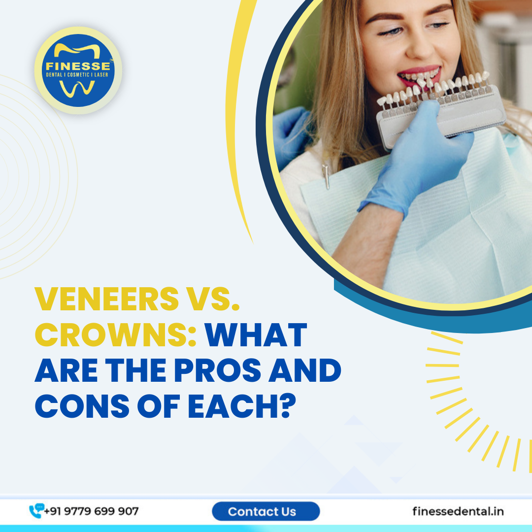 Veneers vs. Crowns What Are the Pros and Cons of Each? by Finesse