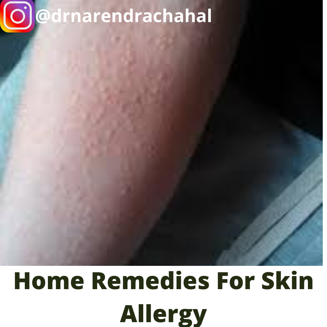 Everything You Ever Wanted To Know About Home Remedies For Skin Allergy But Were Afraid To Ask 4777