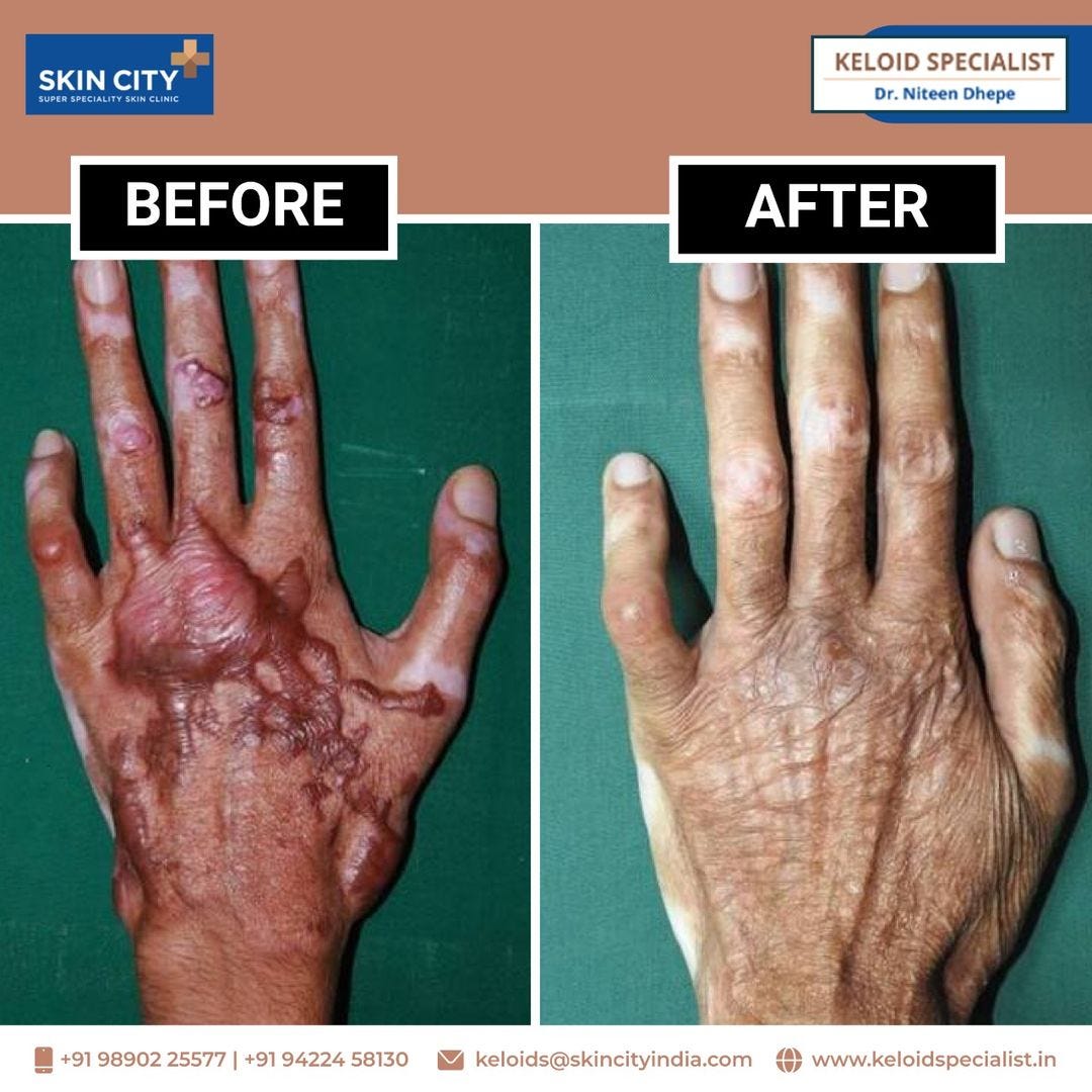 Keloid Treatment At Skin City. Before and After a Successful Keloid