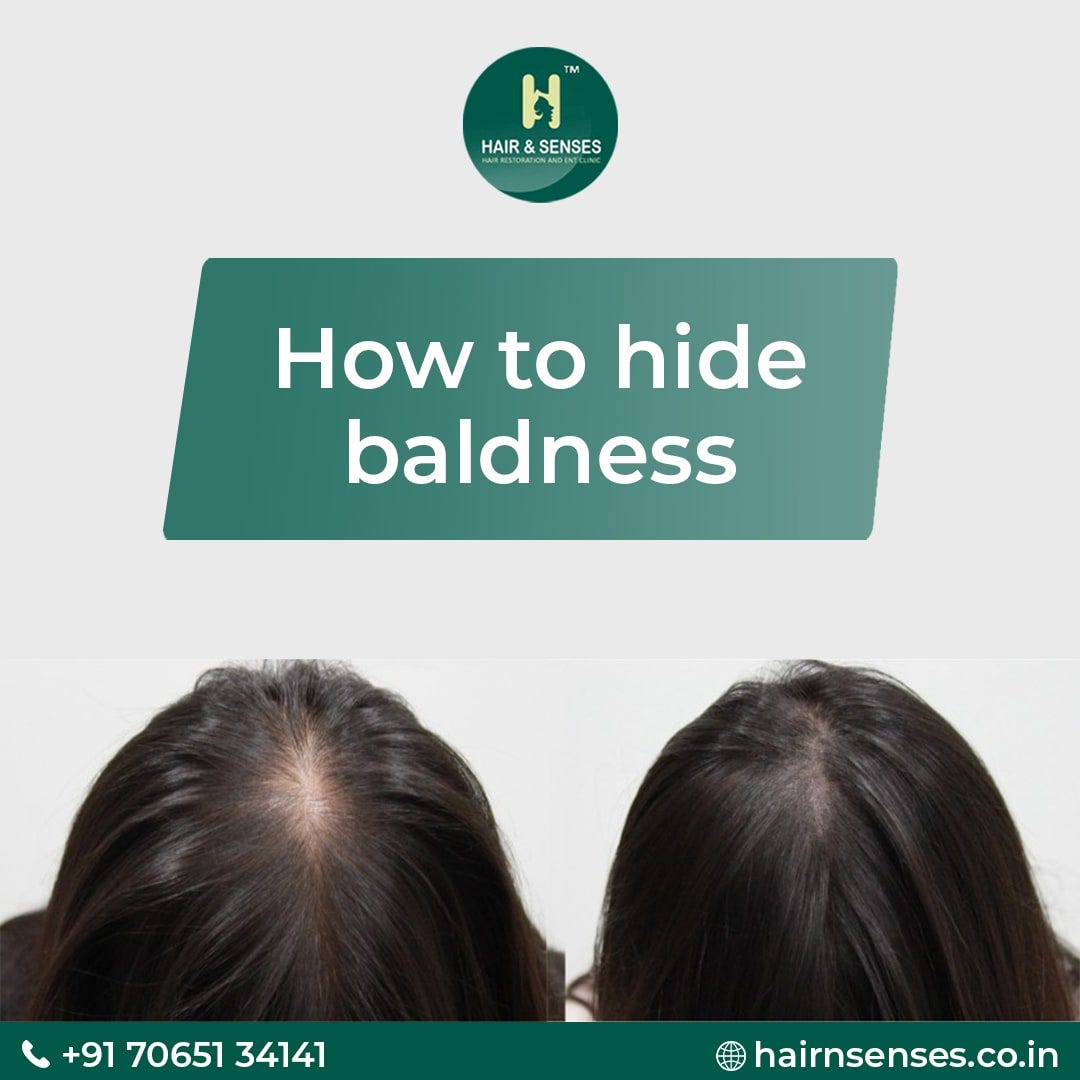 How to Cover Up Baldness. Hair & Senses Medium