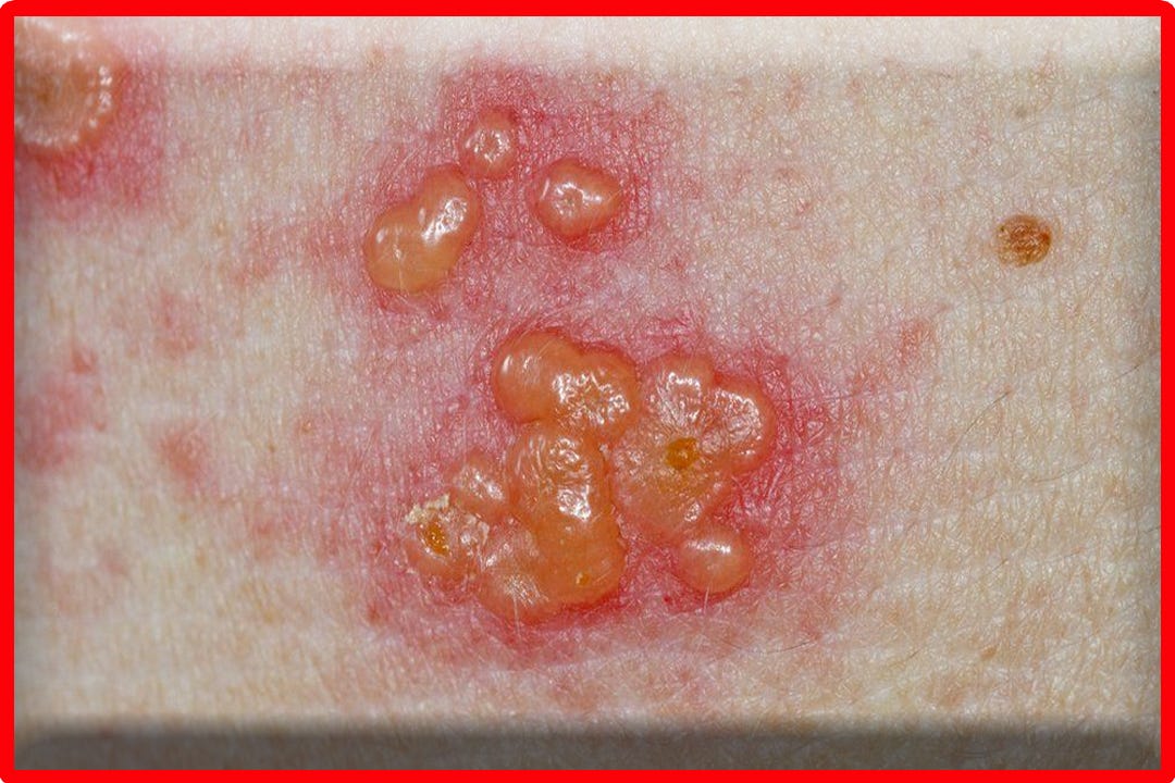 What Is Shingles Blisters And Its Symptoms Digital Marketer Medium