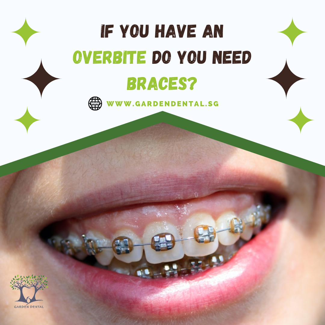 If you have an overbite do you need braces — Garden dental