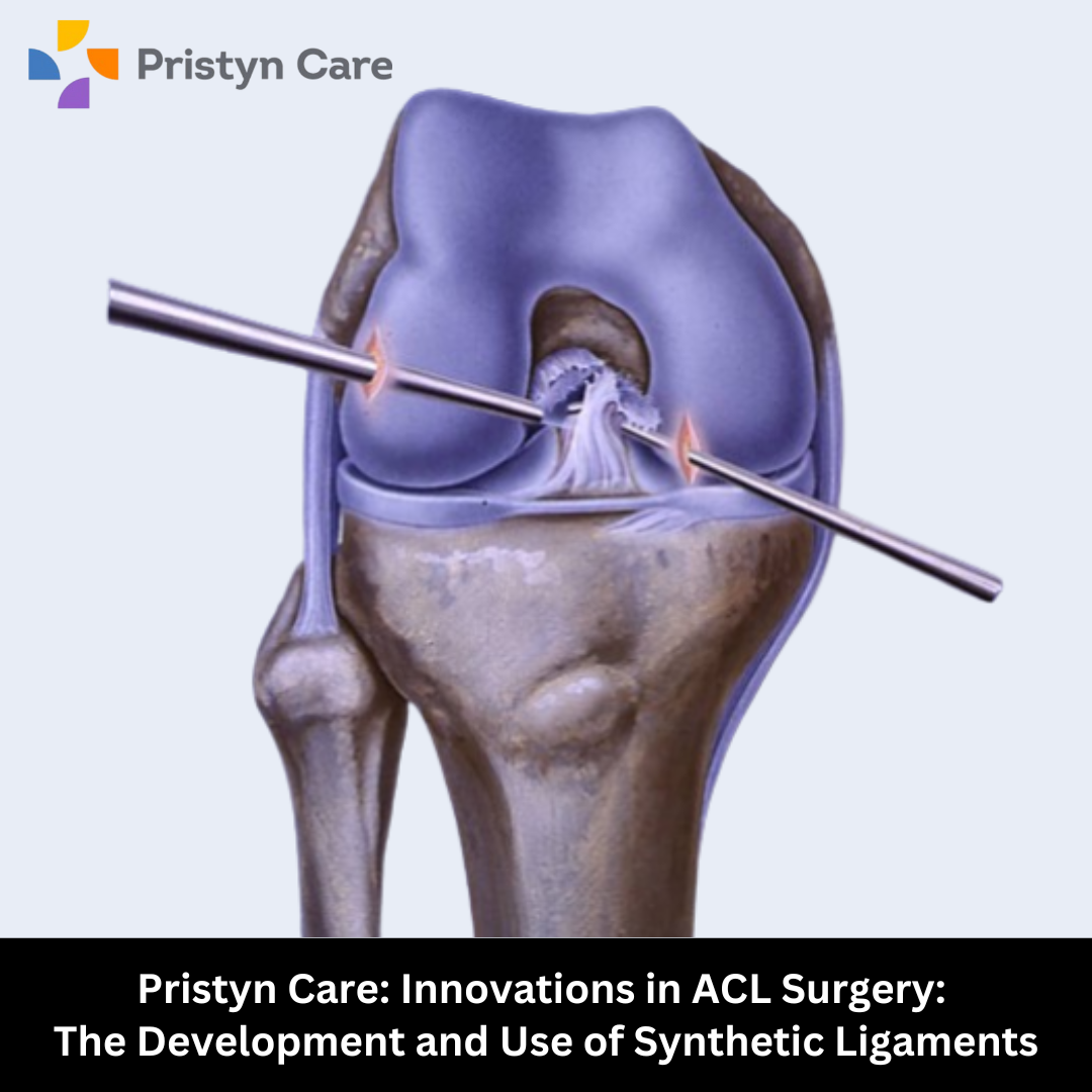 Pristyn Care Innovations in ACL Surgery The Development and Use of