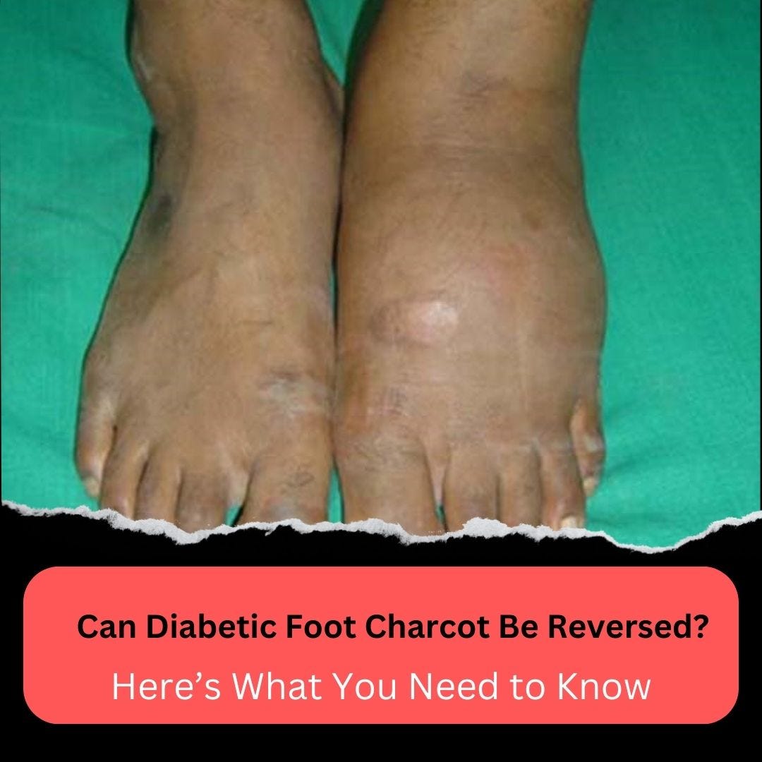 Can Diabetic Foot Charcot Be Reversed? Here’s What You Need to Know