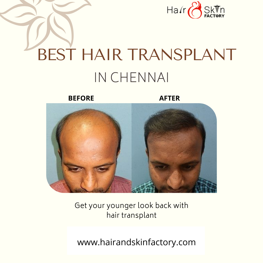 Best hair transplant in chennai Esapavan Medium