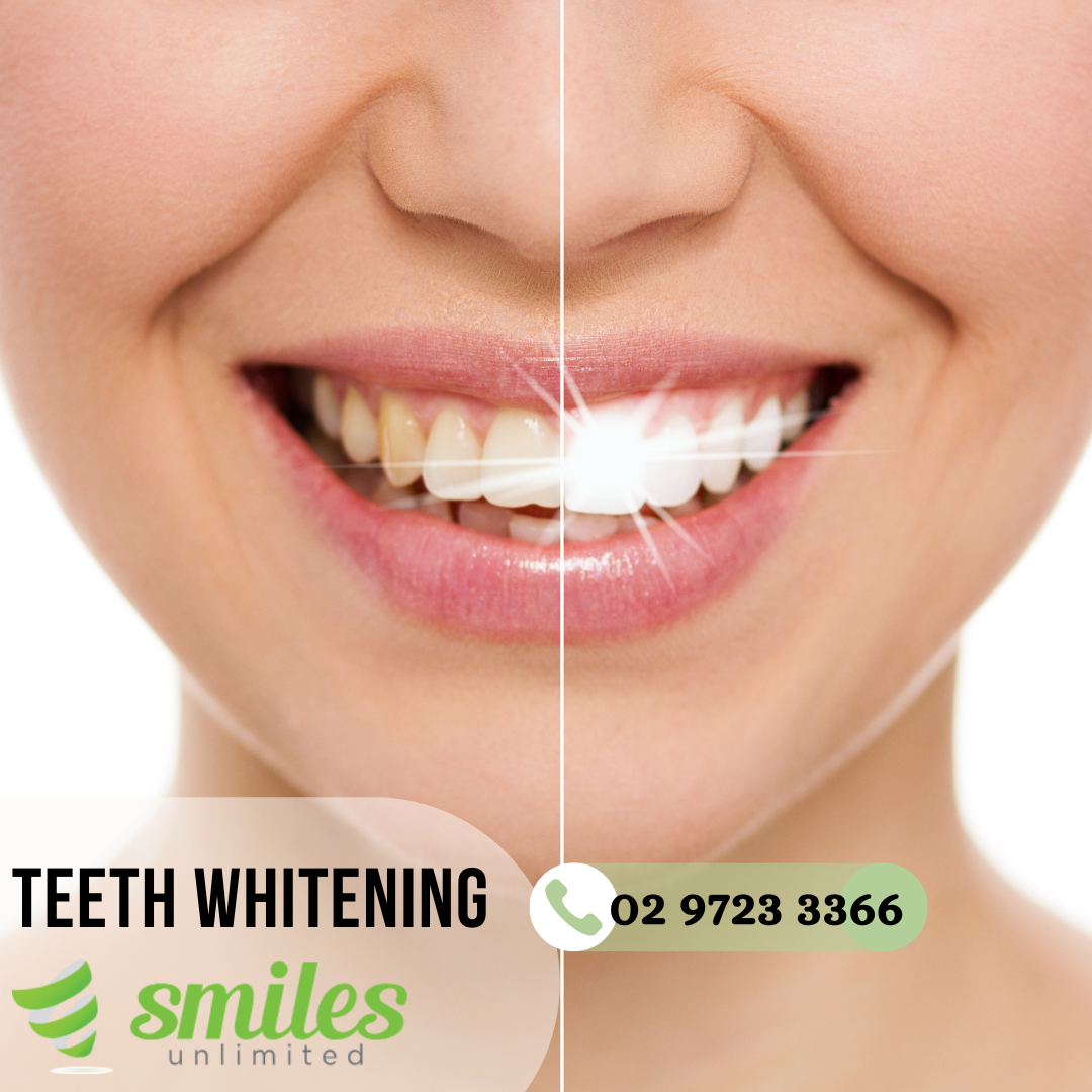 Discover the Magic of Teeth Whitening at Smiles Unlimited Smiles
