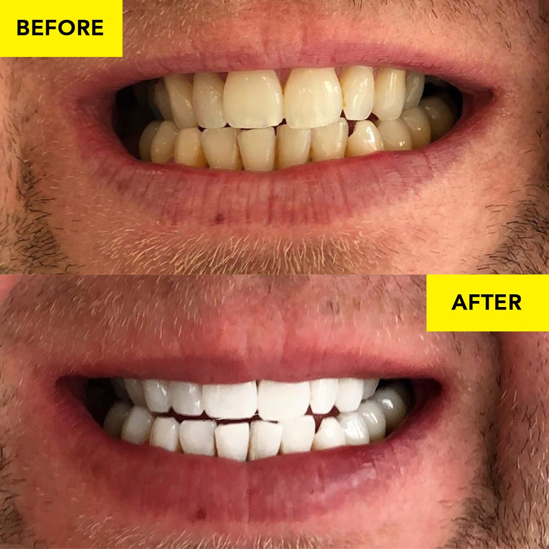 Teeth Whitening How it Works and What it Costs by Jimmy Jamez Medium