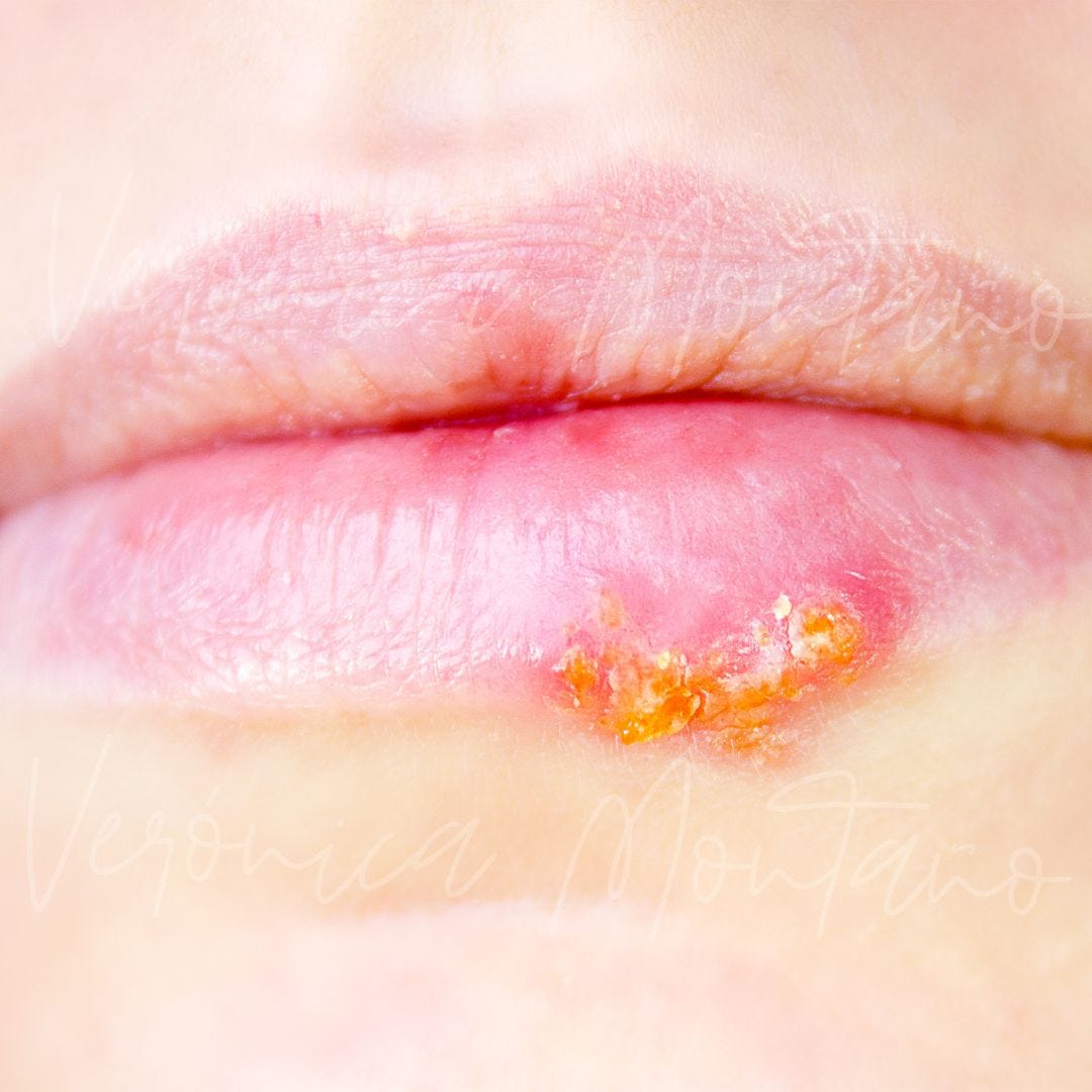 Que es Herpes Labial: Causas y Tratamientos. Lo que todo Micropigmentador debe Saber