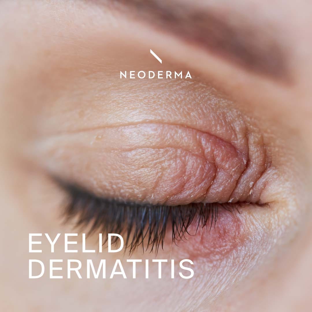 The Photos of Eyelid Dermatitis — NEODERMA NEODERMA Medium