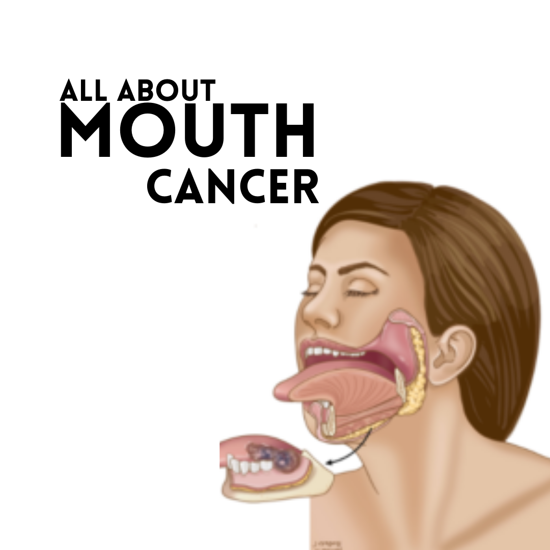 A Guide to Mouth Cancer:. A Guide to Mouth Cancer: | by Spirals Health ...