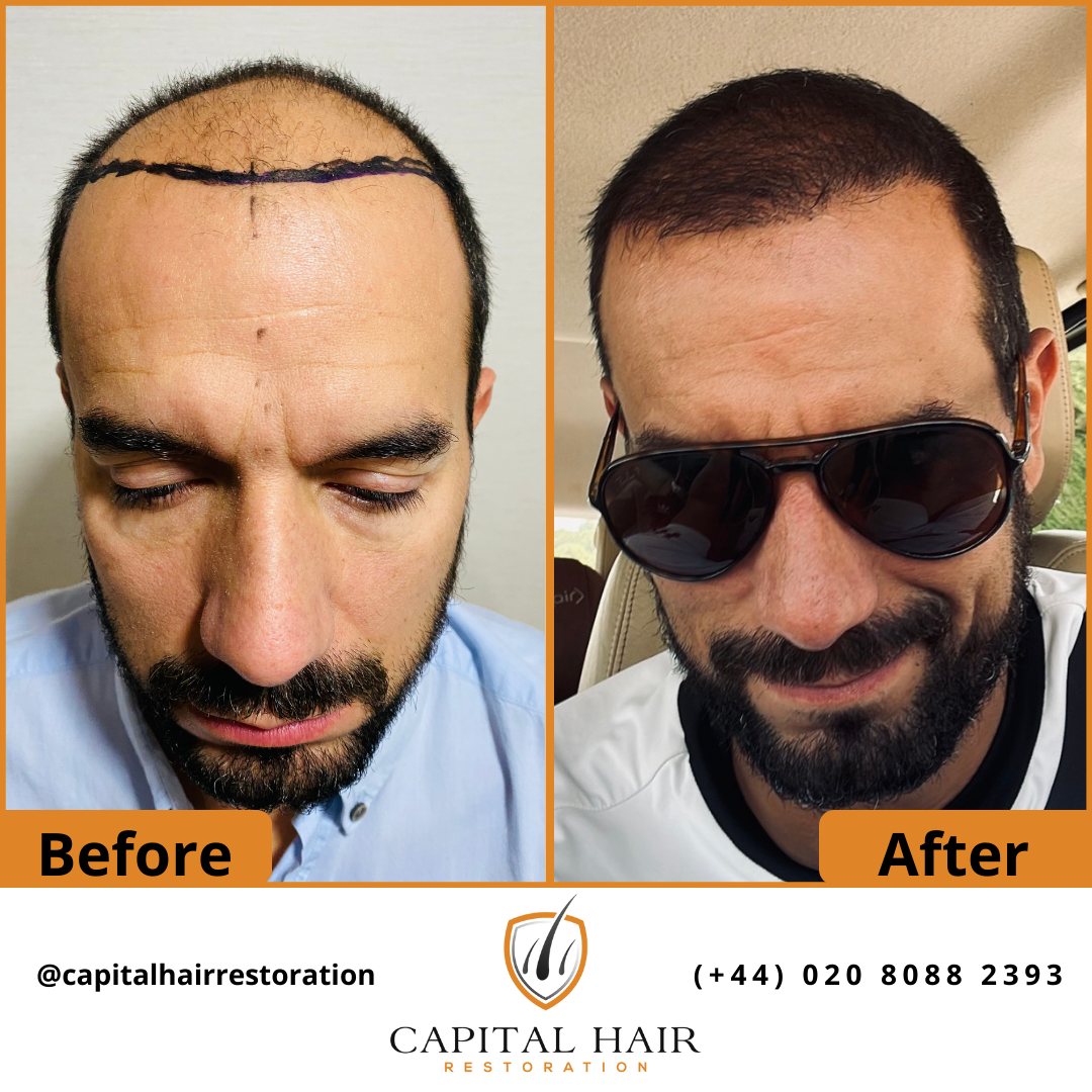 Capital Hair Restoration Leading the Way in Hair Transplantation in London by Hair Transplant
