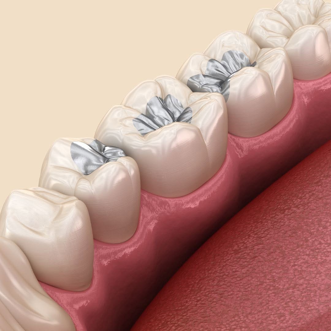 Professional Dental Crowns in Johns Island, SC