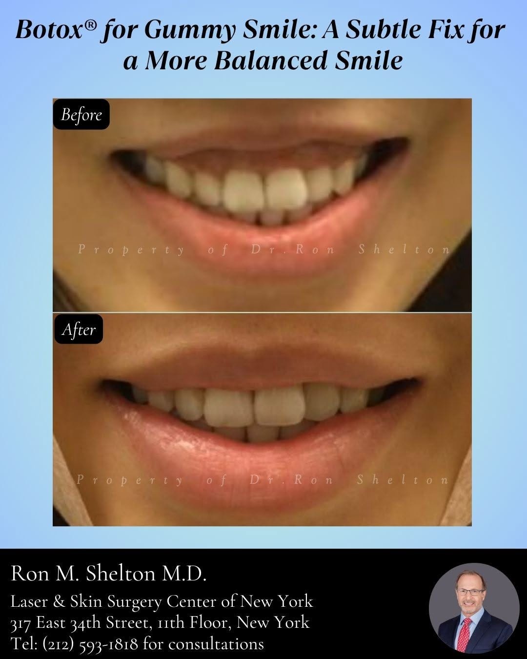 A More Balanced Smile with Botox®