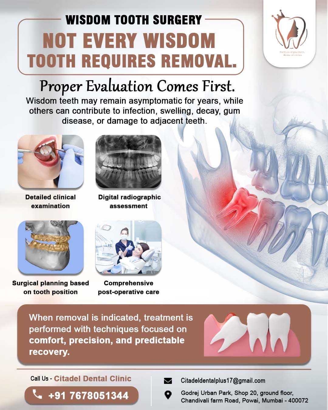 Pain-Free Wisdom Tooth Surgery: Safe Removal & Fast Recovery
