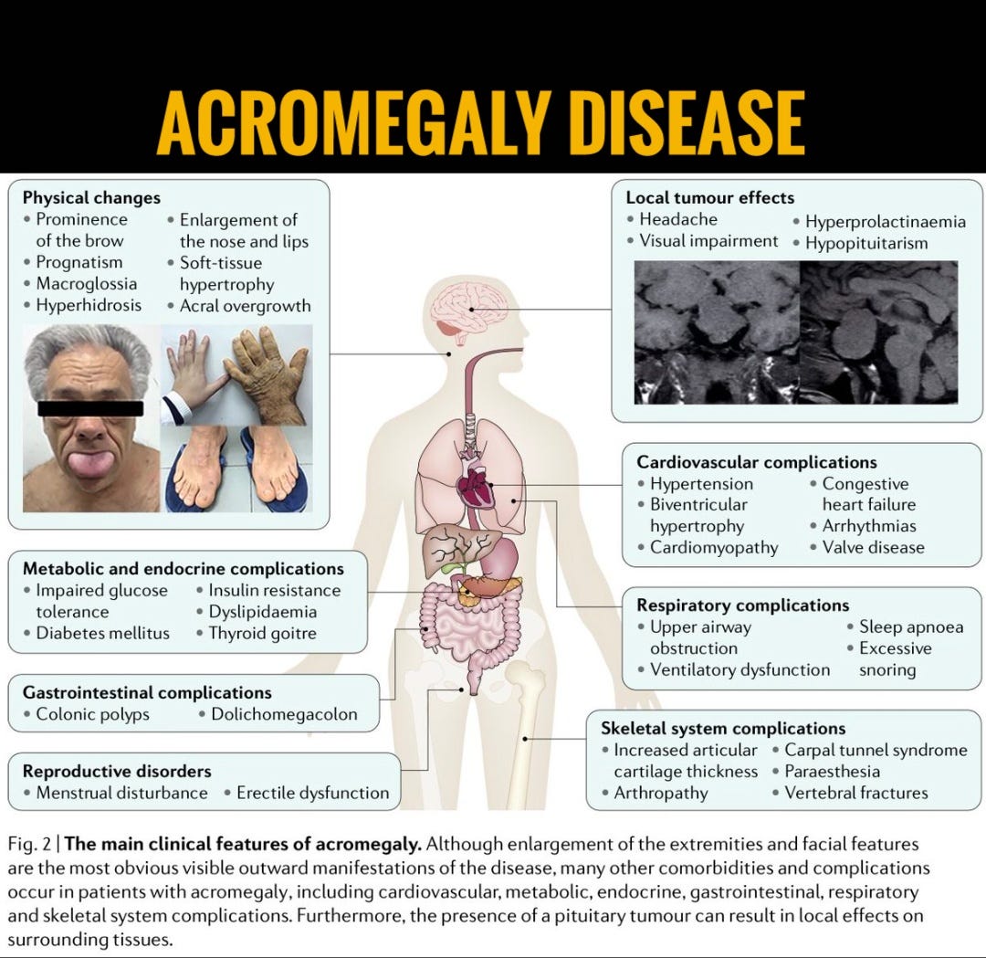 Understanding Acromegaly: Symptoms, Diagnosis, and Treatments Explained ...