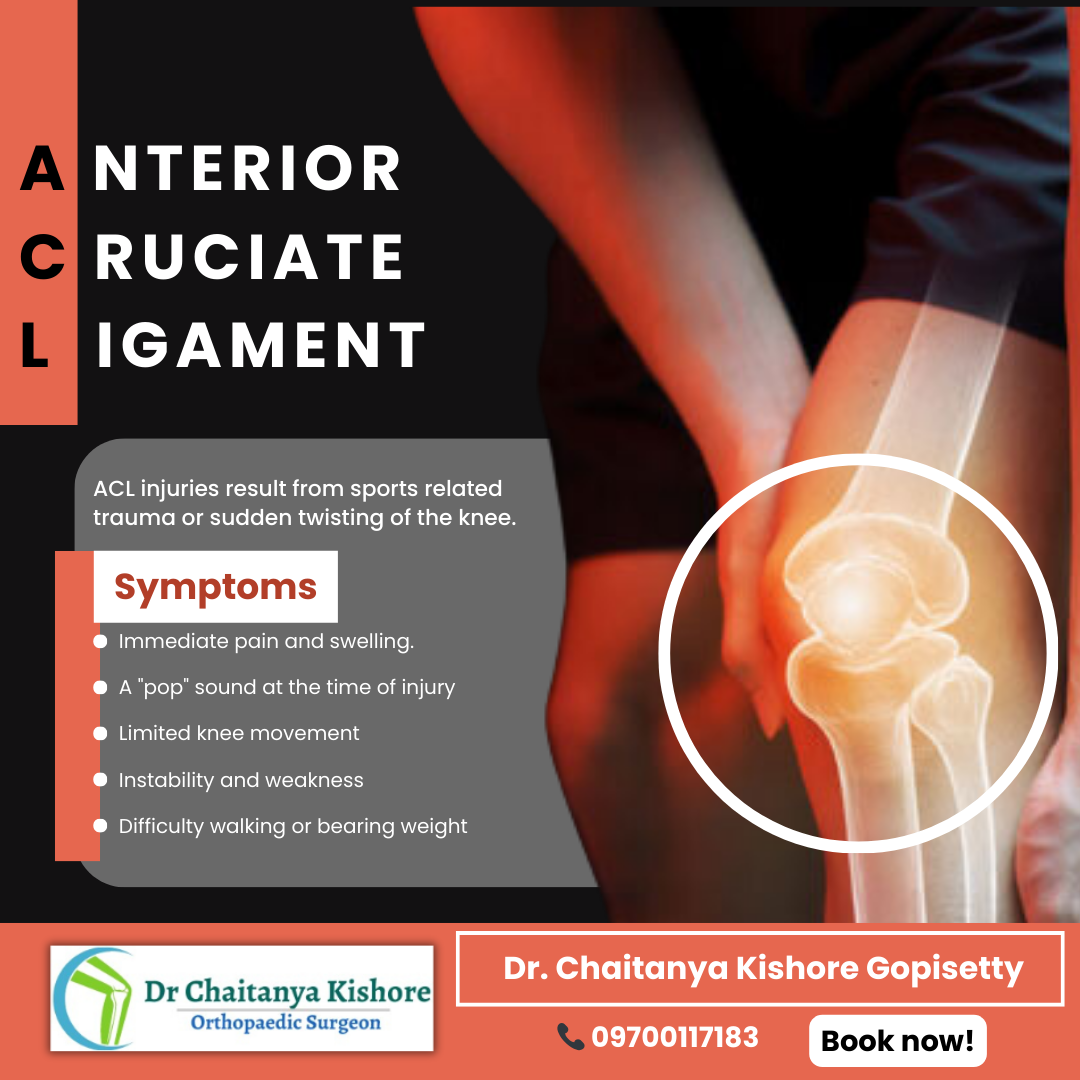 ACL Injury - The Comprehensive Guide to Anterior Cruciate Ligament