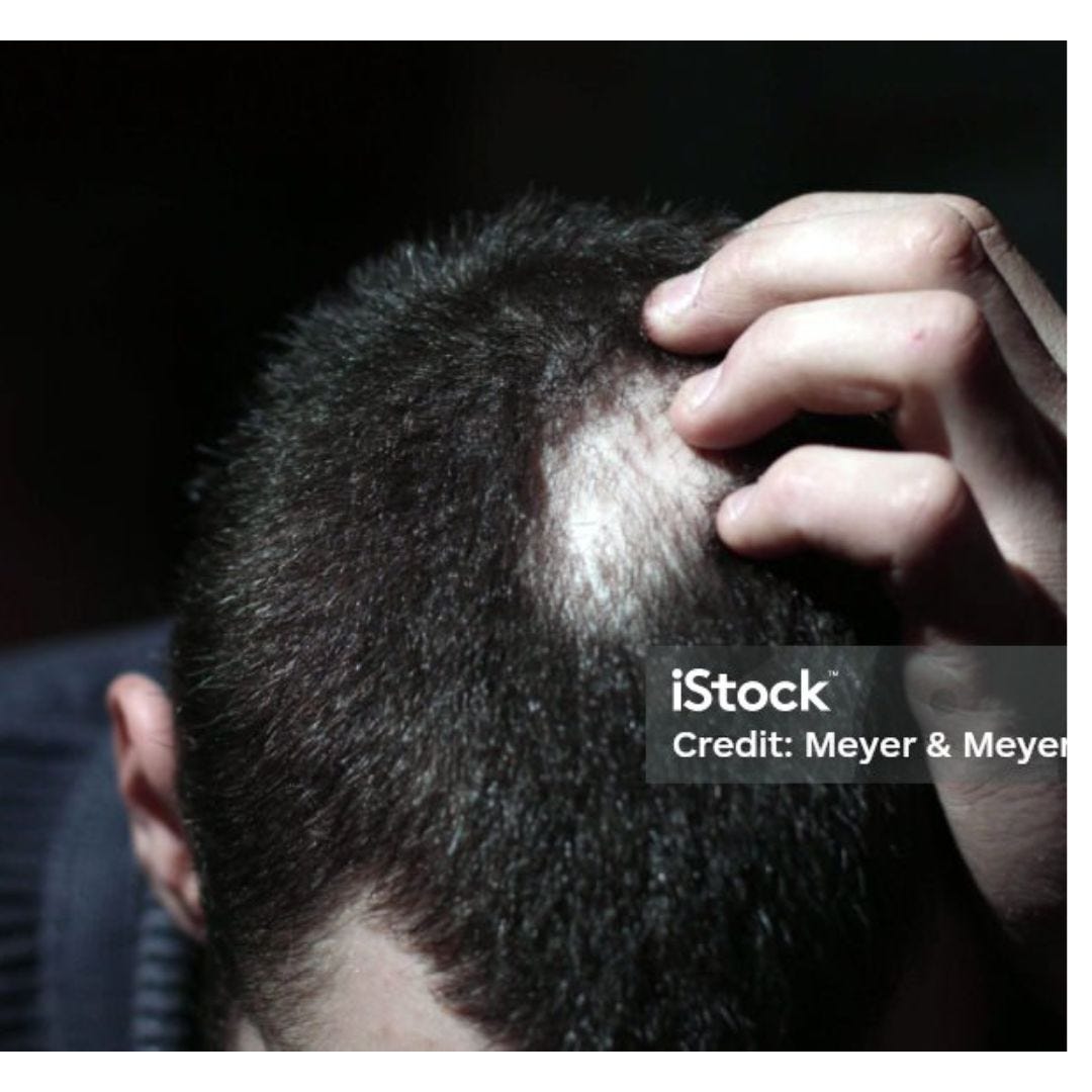 Different Types Of Hair Patch. Exploring Diverse Types of Hair Patch