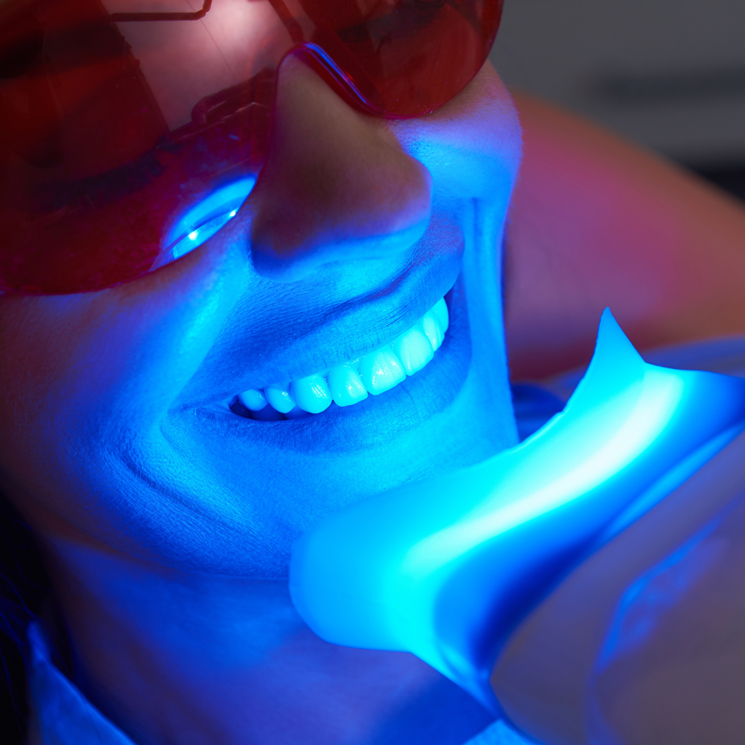 What Makes Teeth Whitening Kits in Singapore A Worthy Investment