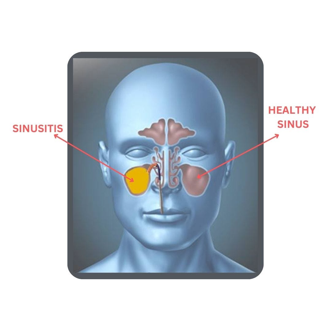 When and Why Sinus Surgery Necessary by Nidheesh Sarovar Oct, 2023 Medium