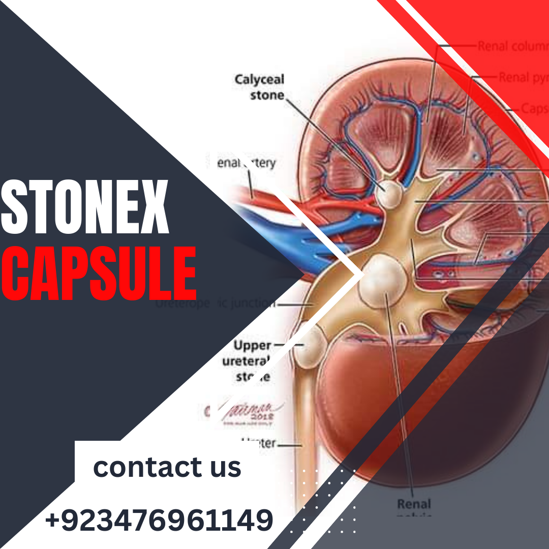 Stonex capsule price in Pakistan
+923476961149 |Treatment of kidney stone without surgery|