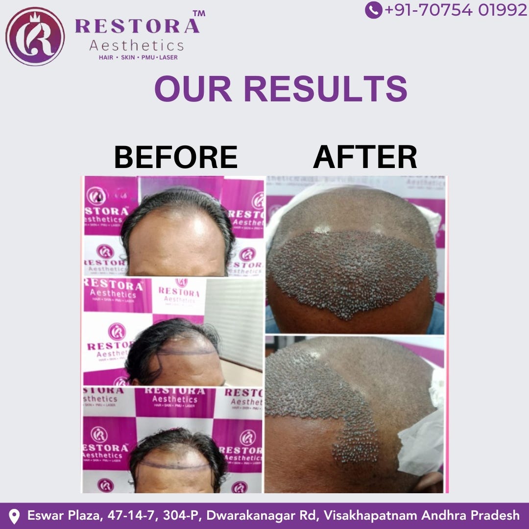 Best Hair Transplant in Vizag - Restora Aesthetics - Medium