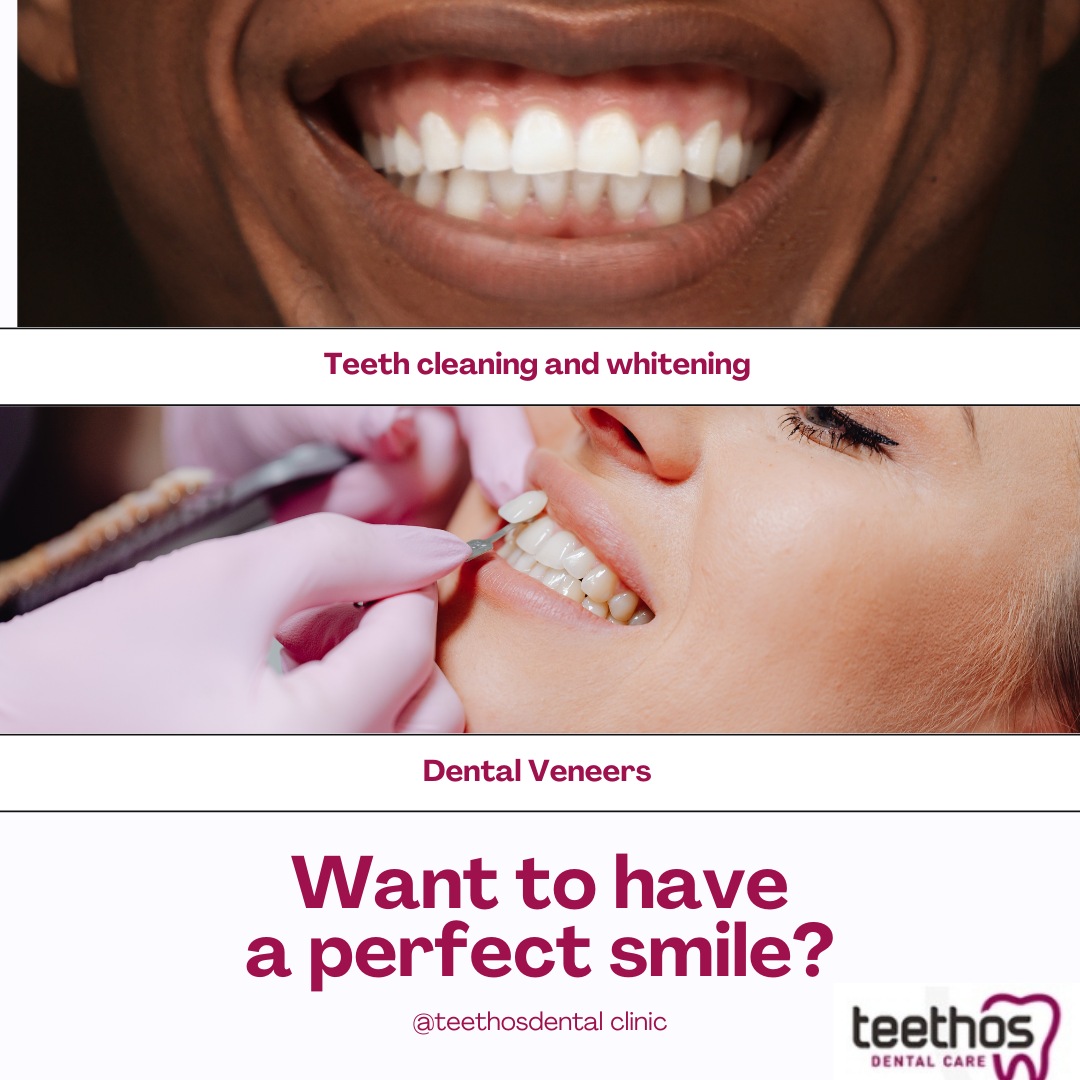 Understanding Teeth Cleaning and Whitening Cost, Dental Veneers Cost in