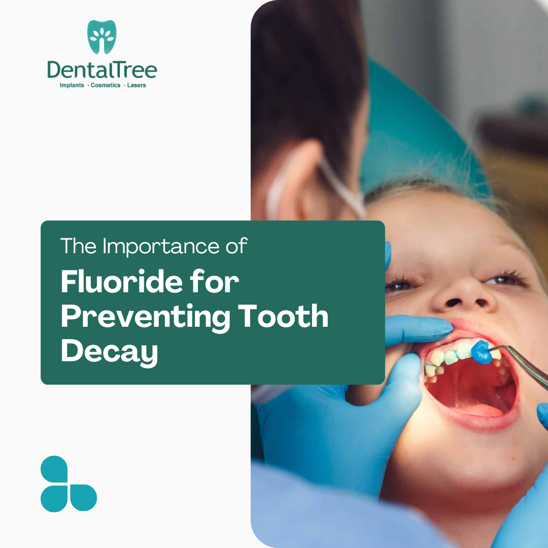 Fluoride’s Role in Preventing Tooth Decay Best Dentist in Aundh Pune