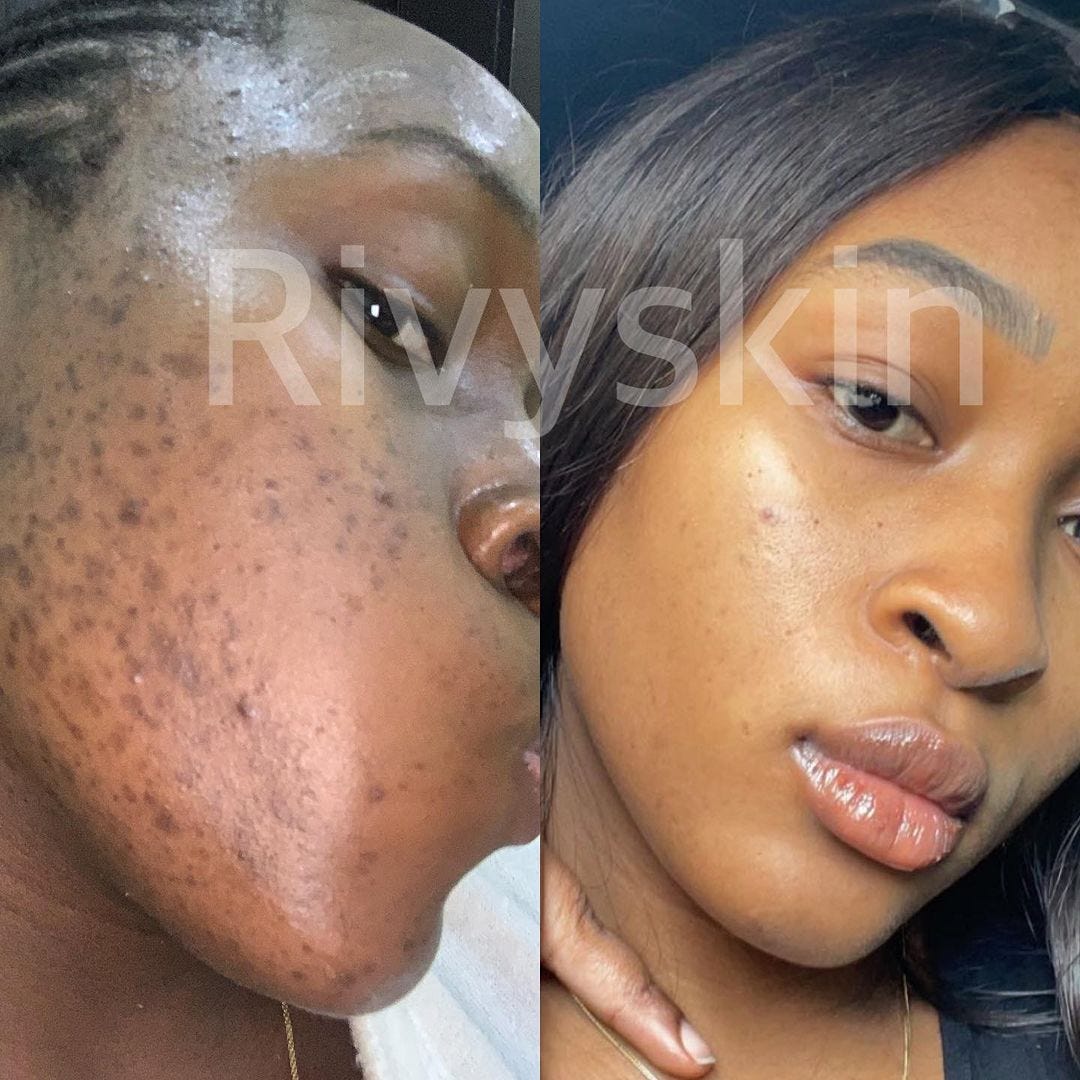 Why is my hyperpigmentation not fading? A Journey to freedom from