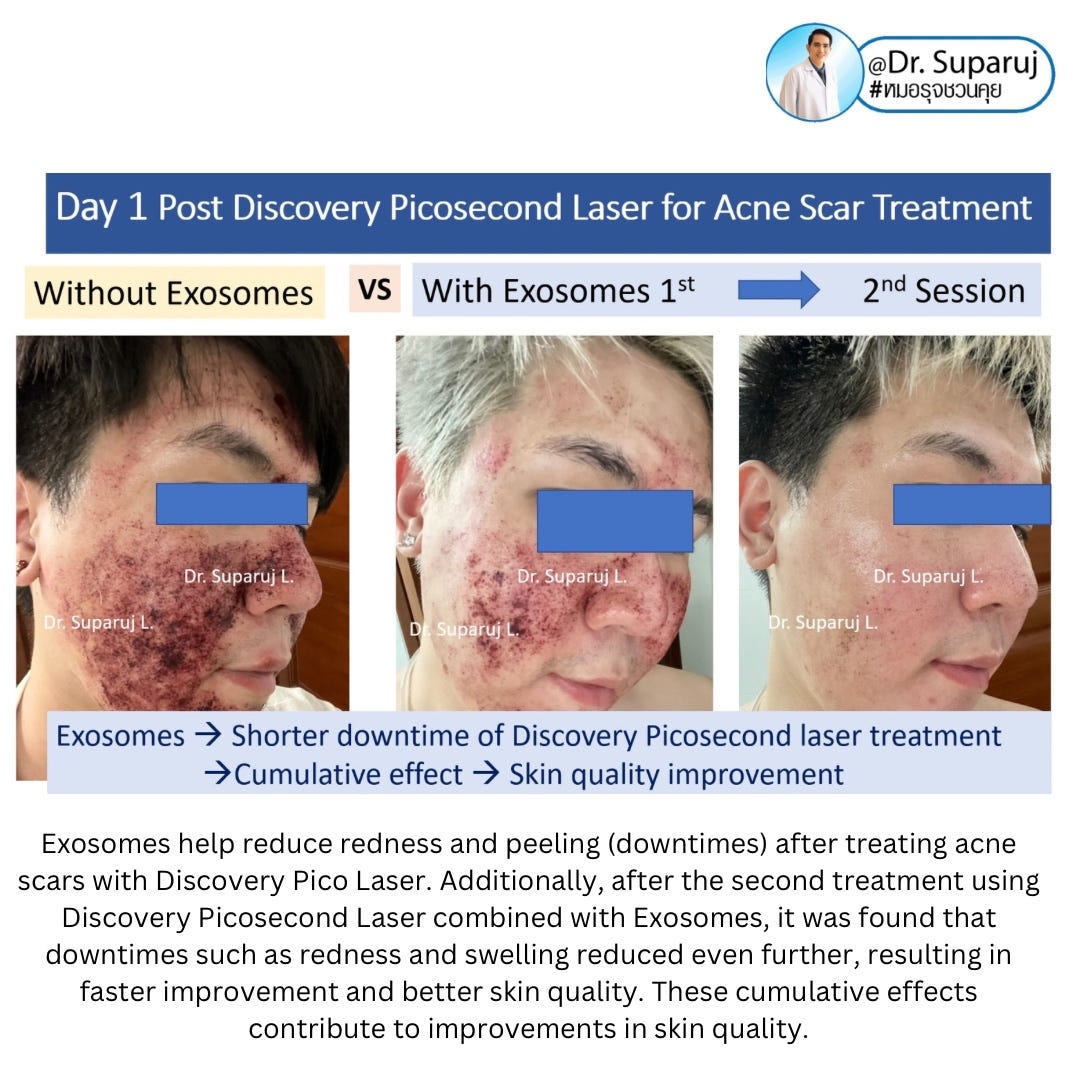 Exosomes help reduce redness and peeling (downtimes) after treating