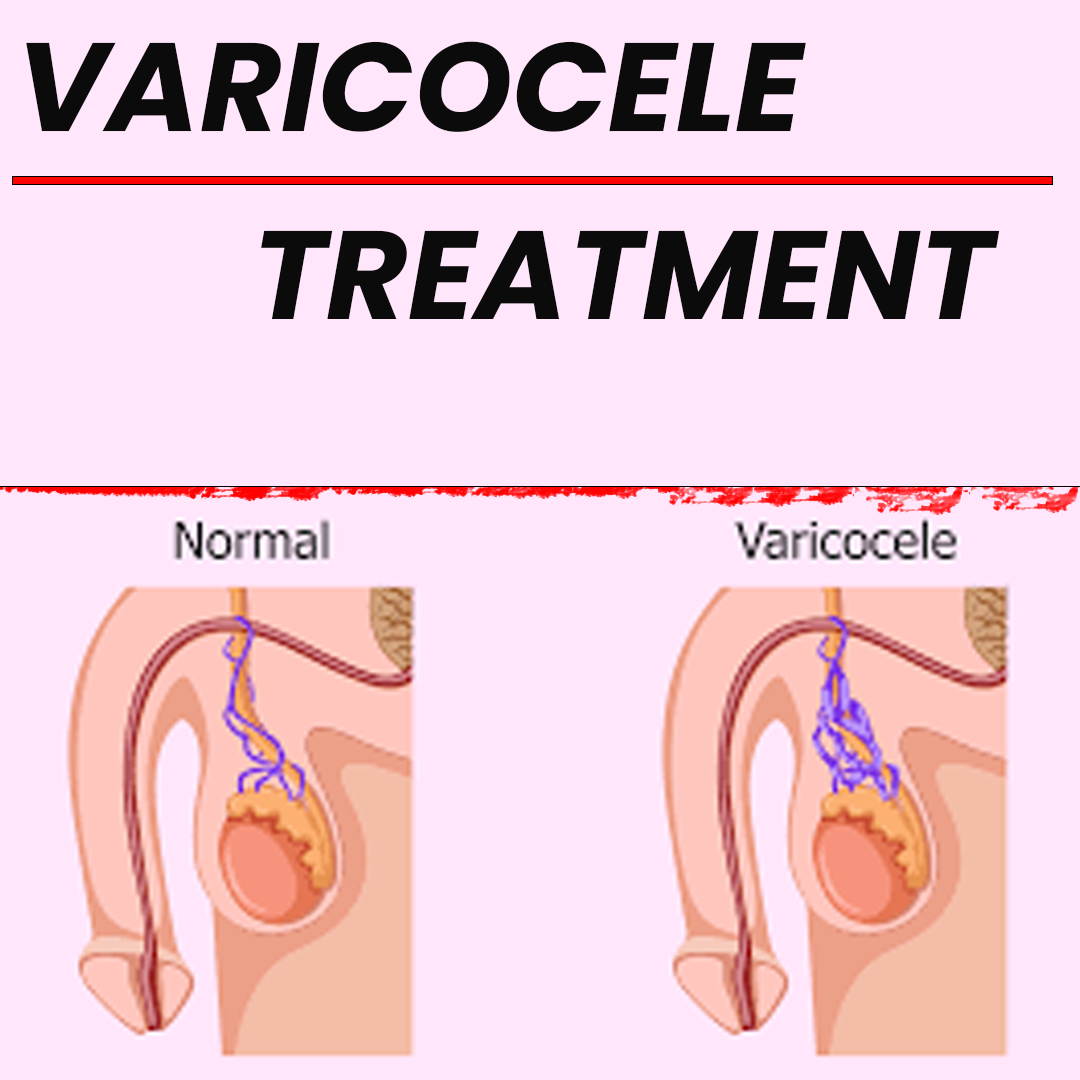 Varicocele Be Gone: Exploring Effective Treatments, by bharat homeopathy