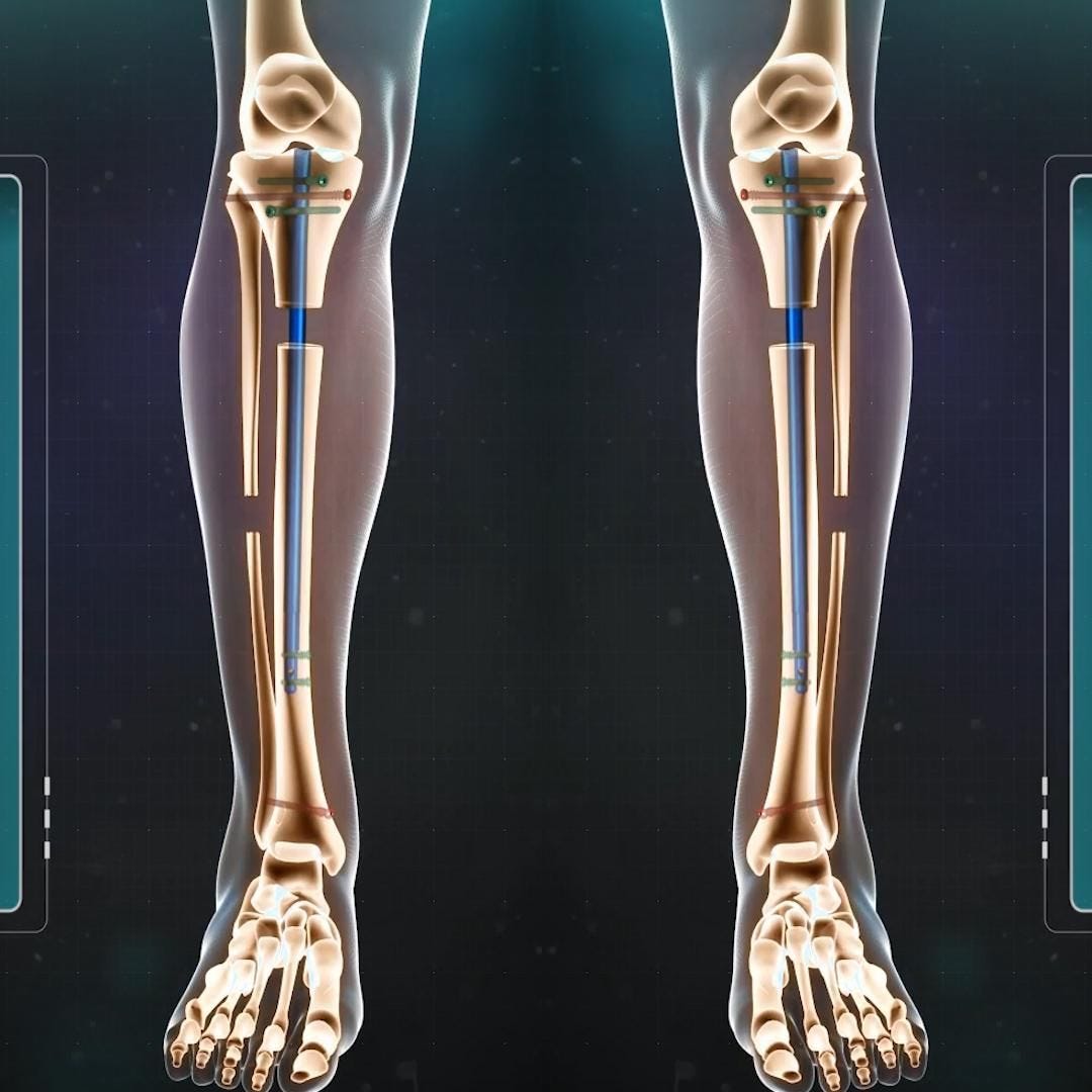 LEG LENGTHENING SURGERY. INTRODUCTION by Ayesha Munir Medium