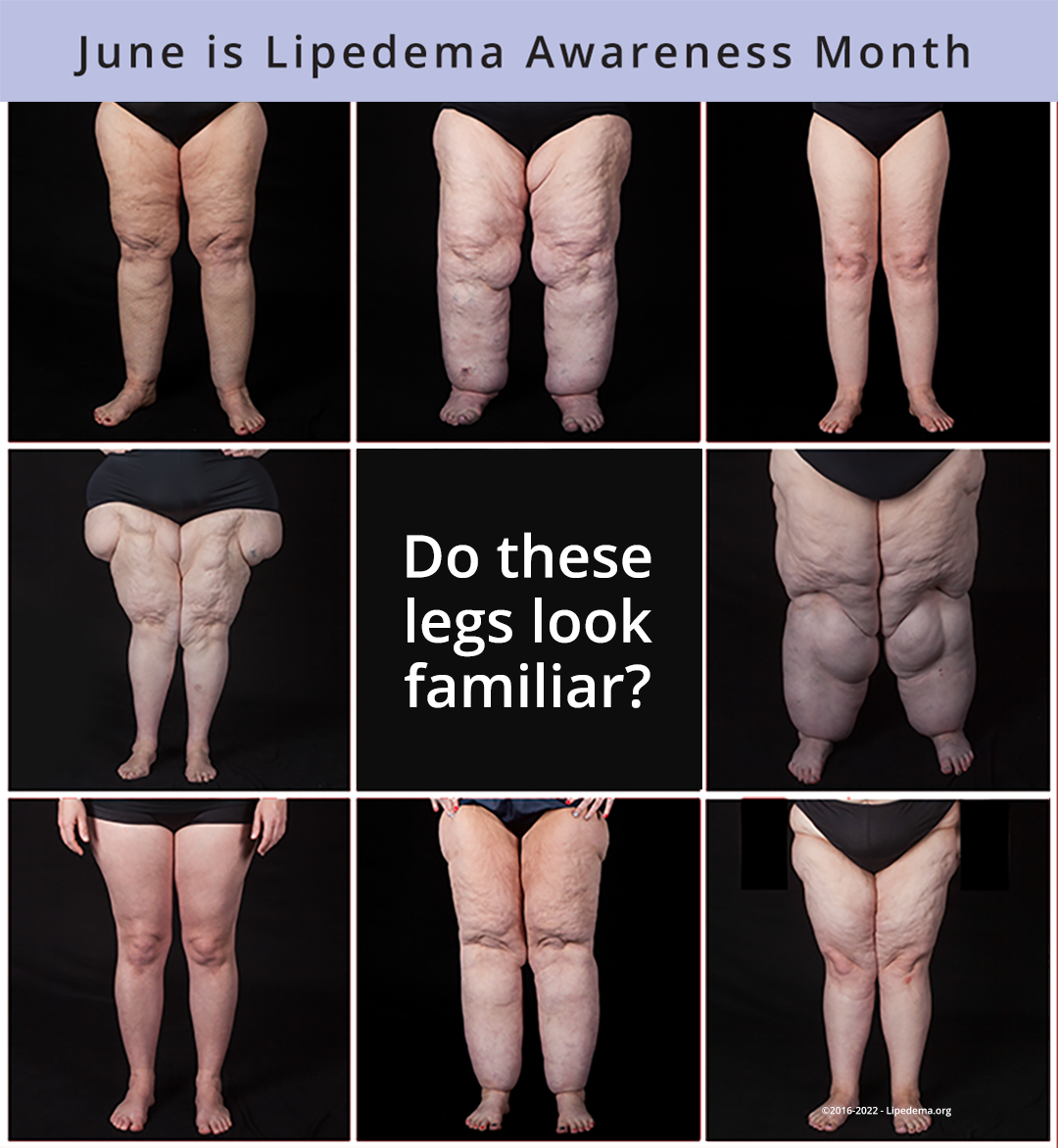 Living with Lipedema. The fat disease, by WriterKat, In Fitness And In  Health