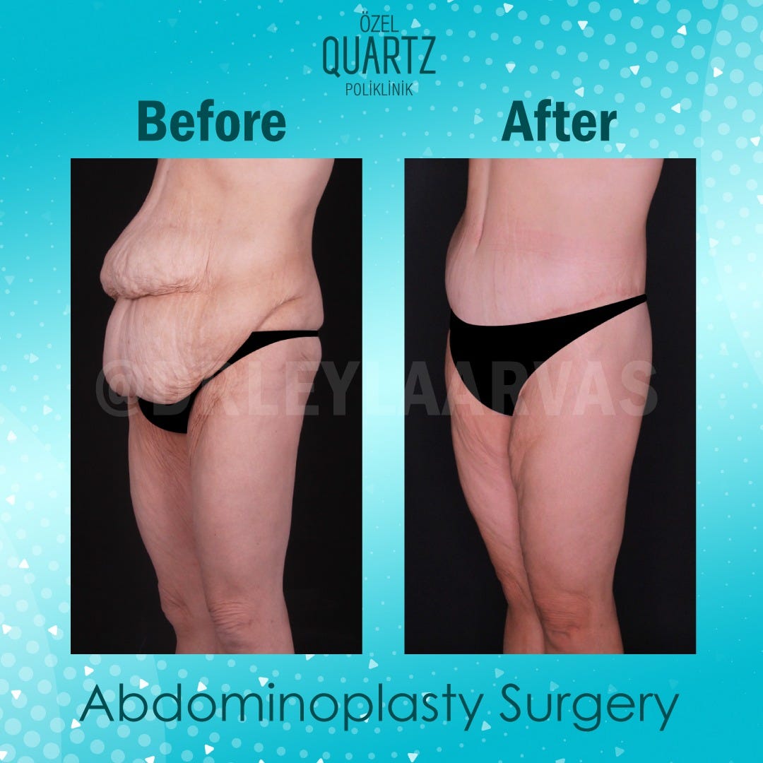 Abdominoplasty “Tummy Tuck”: What You Need to Know Before Going Under the  Knife, by Quartz Clinique