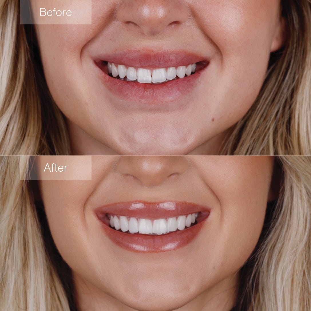 From Imperfections to Perfection The Art of Shaving Teeth for Veneers