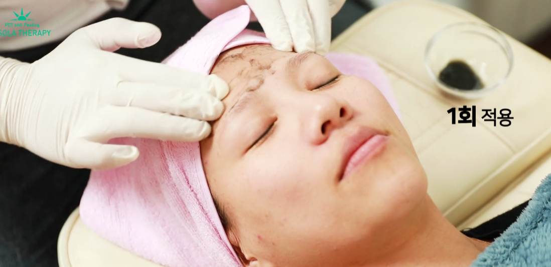 Acne Treatment in Korea: Understanding Your Options at V Clinic Korea