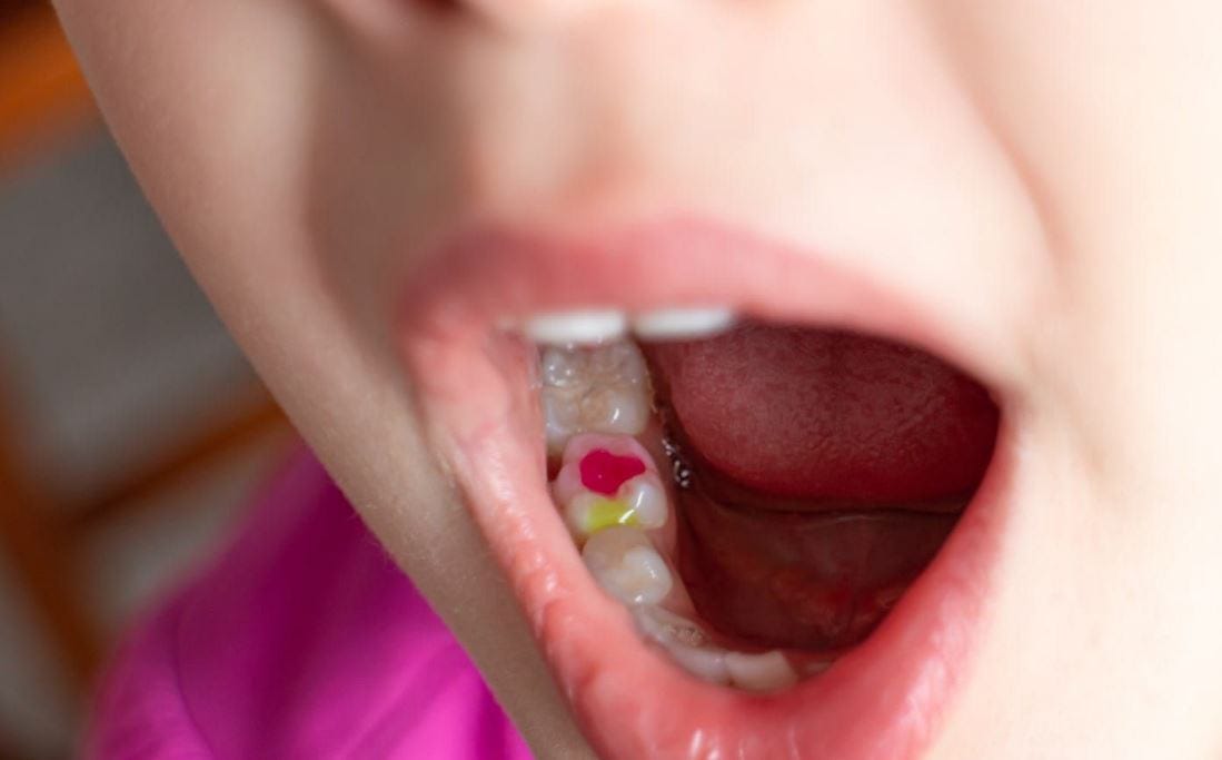 How Long Do Dental Fillings Last? by SunrayPediatricDentistry Medium