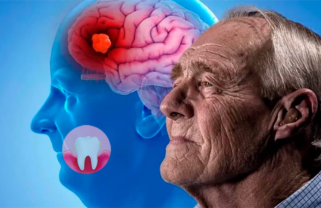 Alzheimer y la Pericoronitis Aguda: Impacto de la Salud Bucal en la Salud Cognitiva