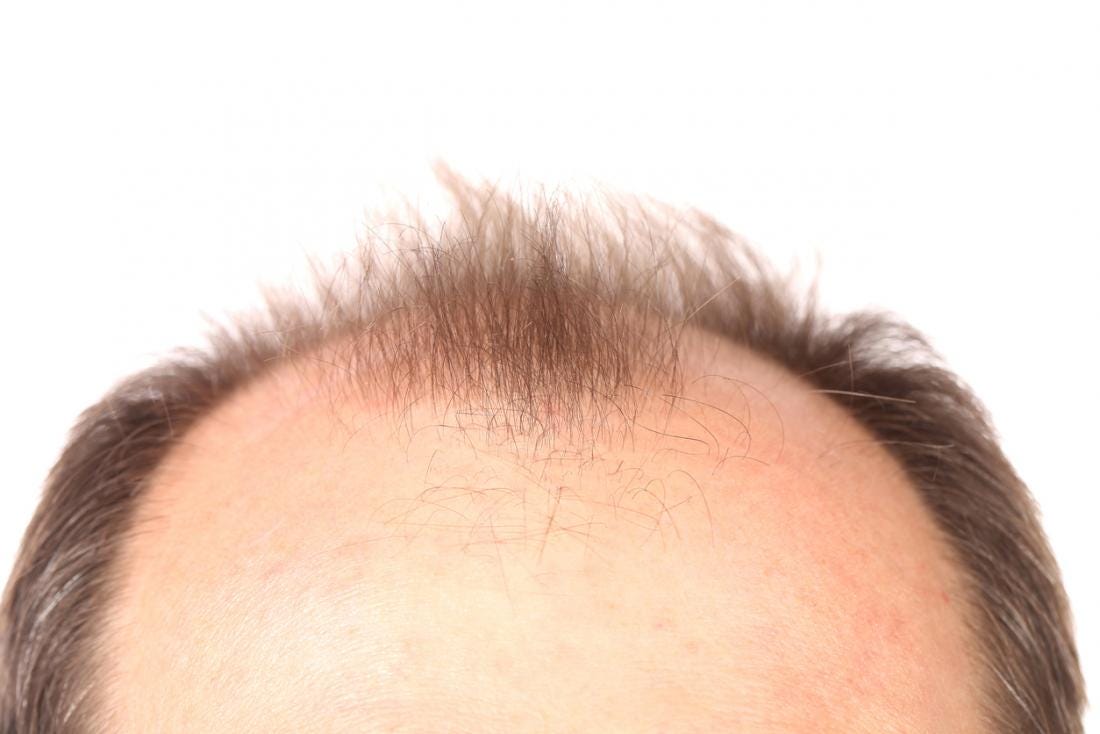 understanding-alopecia-in-order-to-prepare-ourselves-by-john-aug
