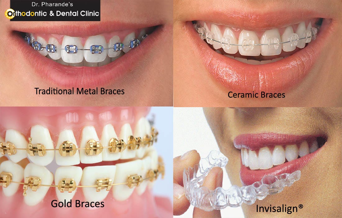 Braces Treatment Specialist In Pune, by DrAmol Pharande