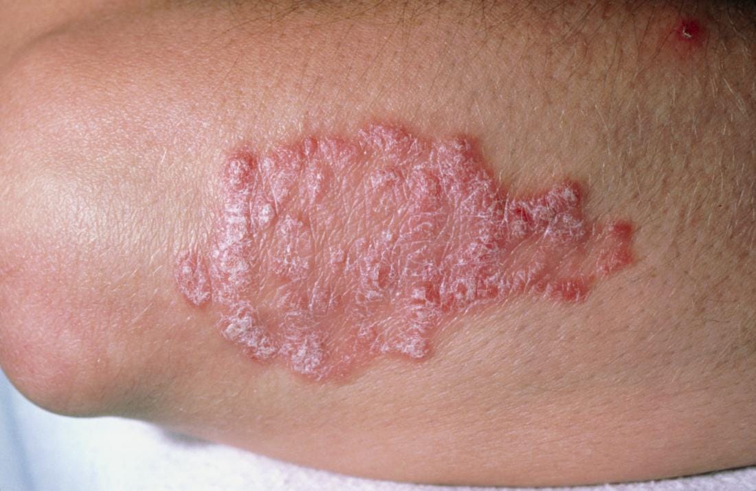 Lupus Disease Symptoms, Causes & Diagnosis by The Expert Knowledge Medium