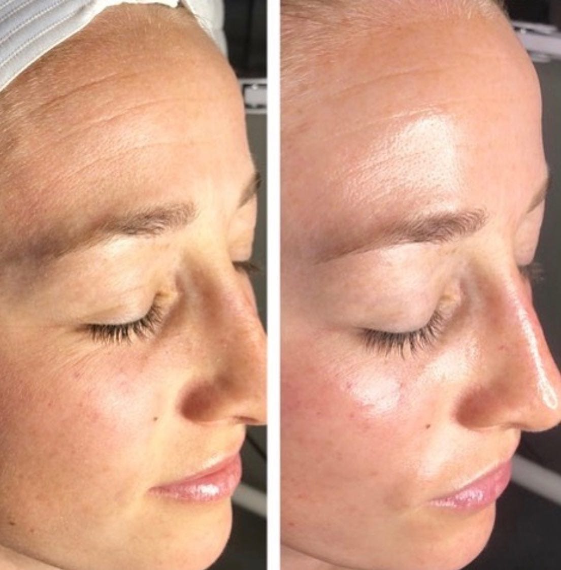 NonSurgical Face Lifting in Queens True Laser Spa New York Medium